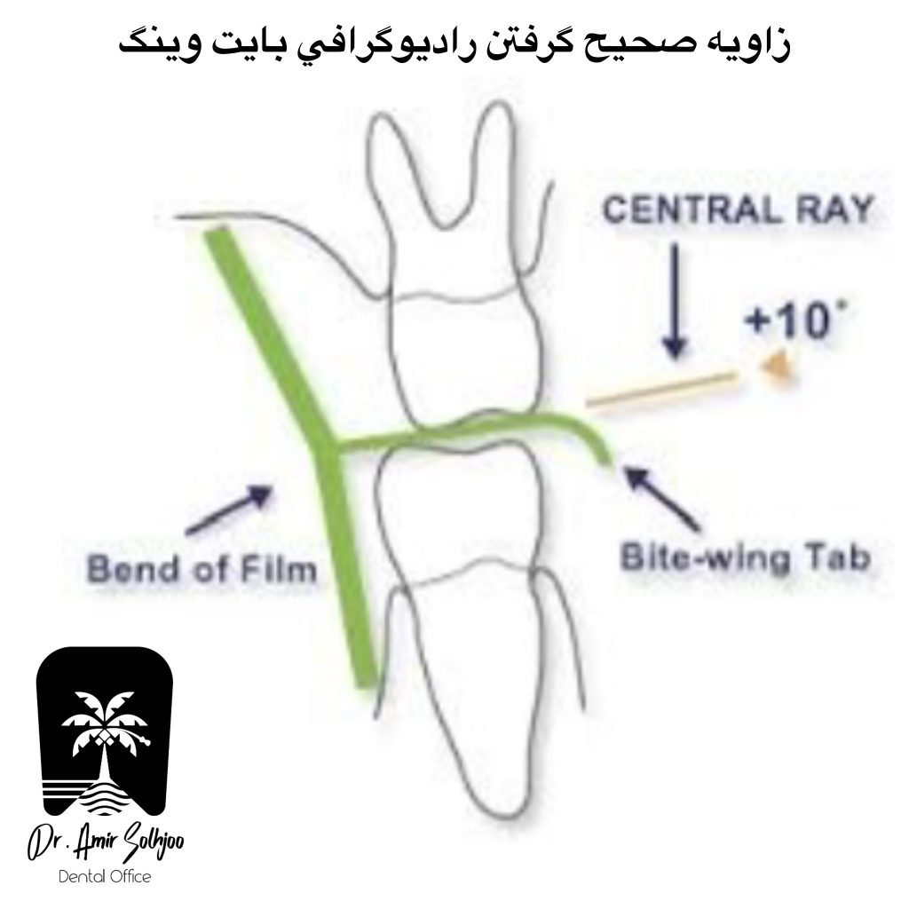 رادیوگرافی بایت وینگ