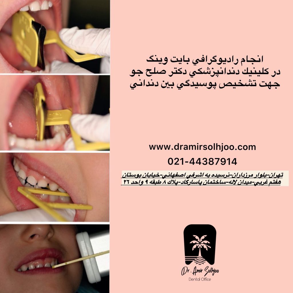 رادیوگرافی بایت وینگ