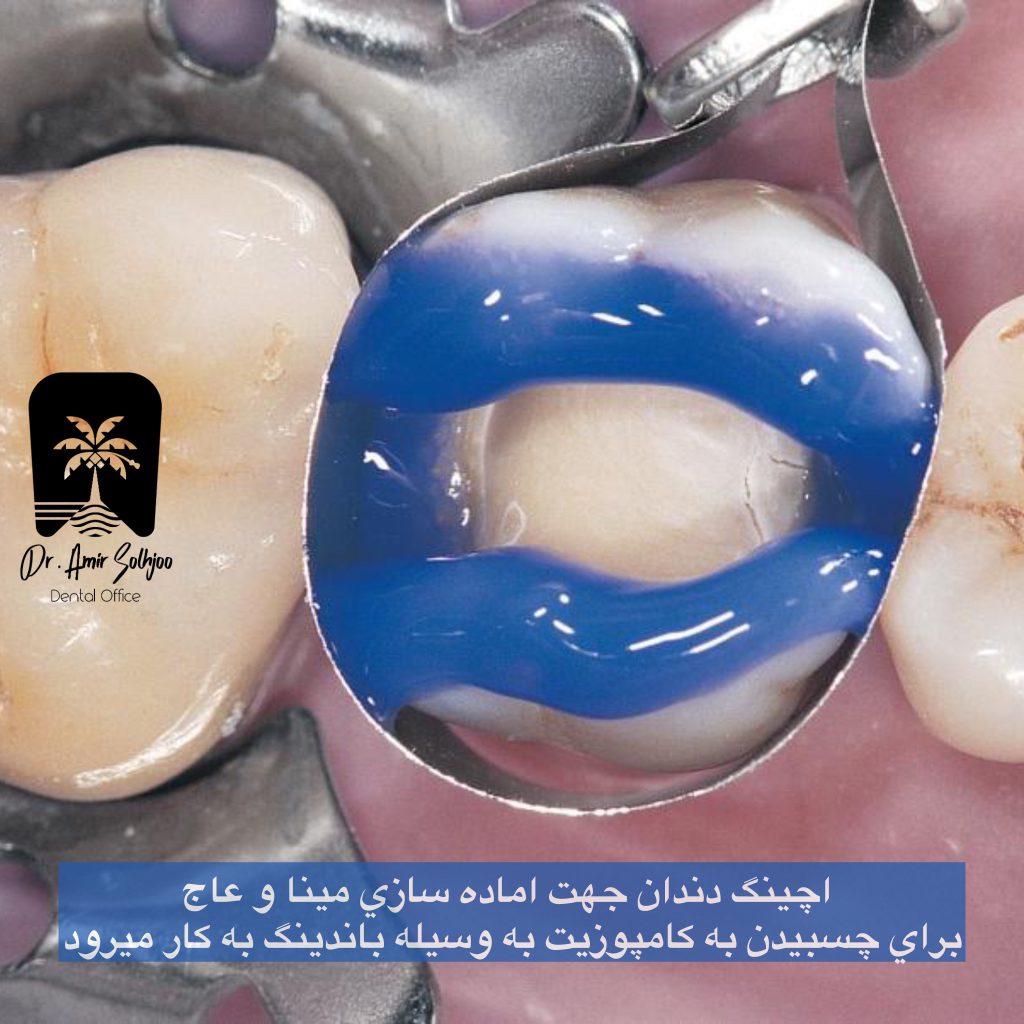 اچینگ دندان
