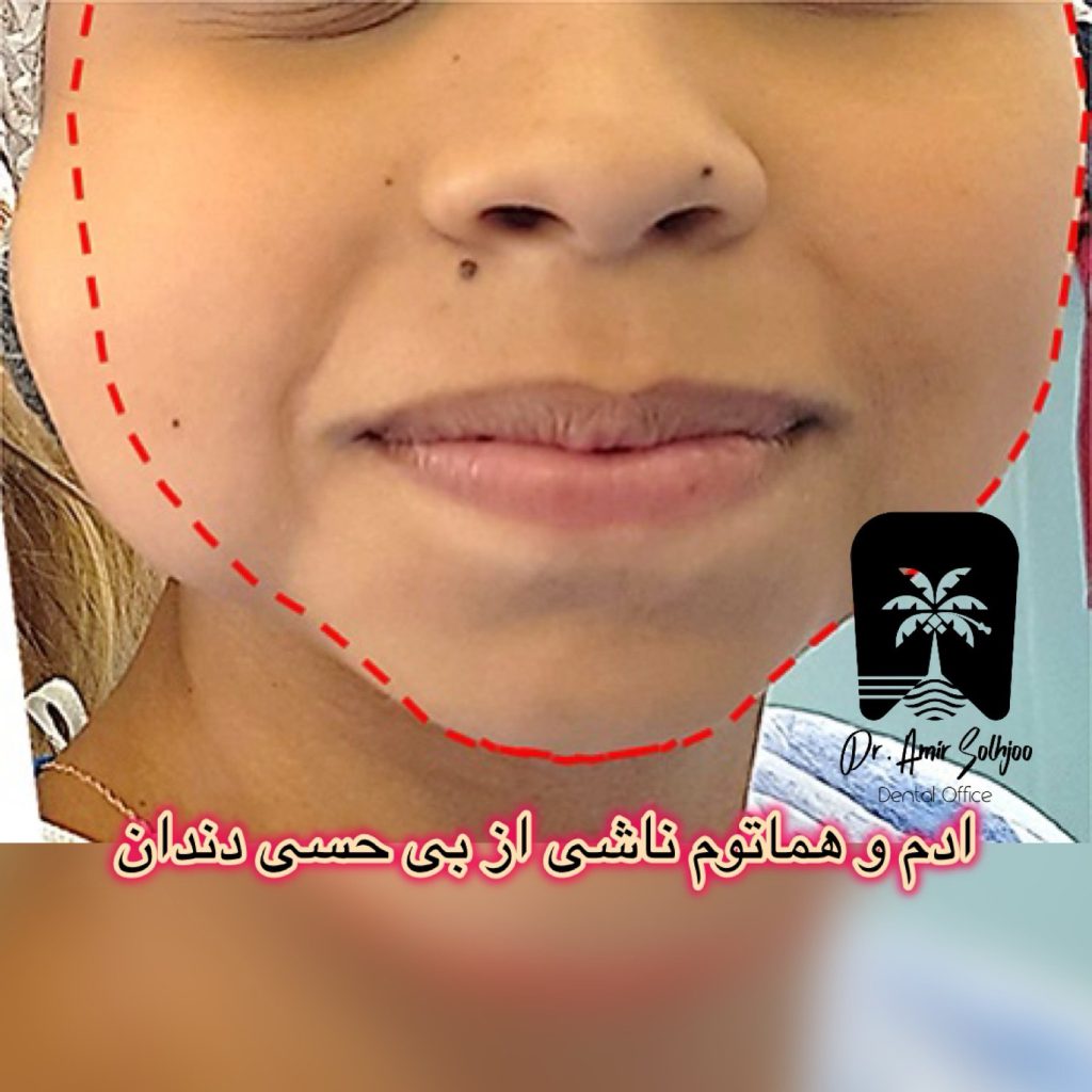 آدم و هماتوم در دندانپزشکی