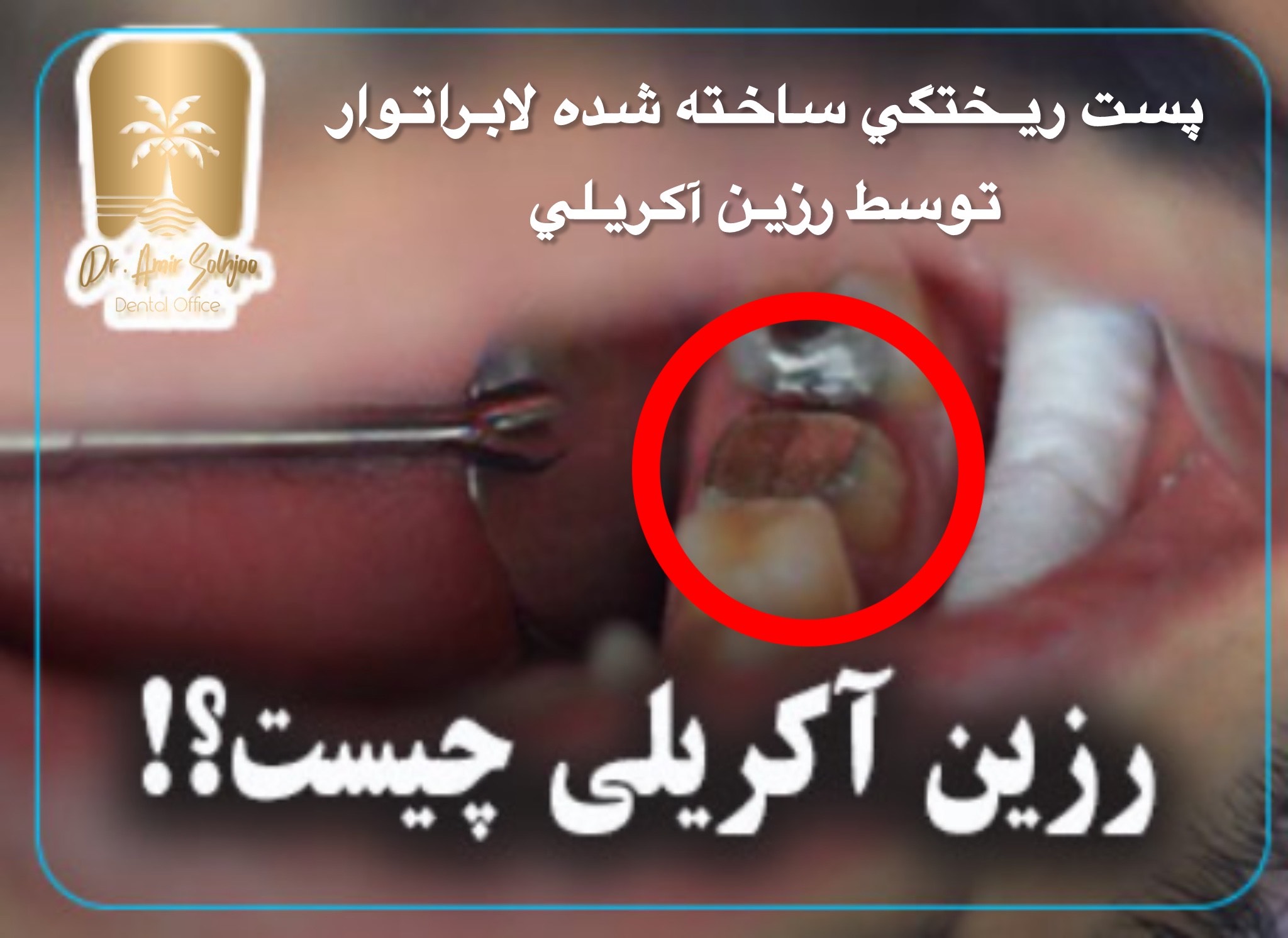 رزین آکریلی