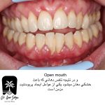 پریودنتیت مزمن