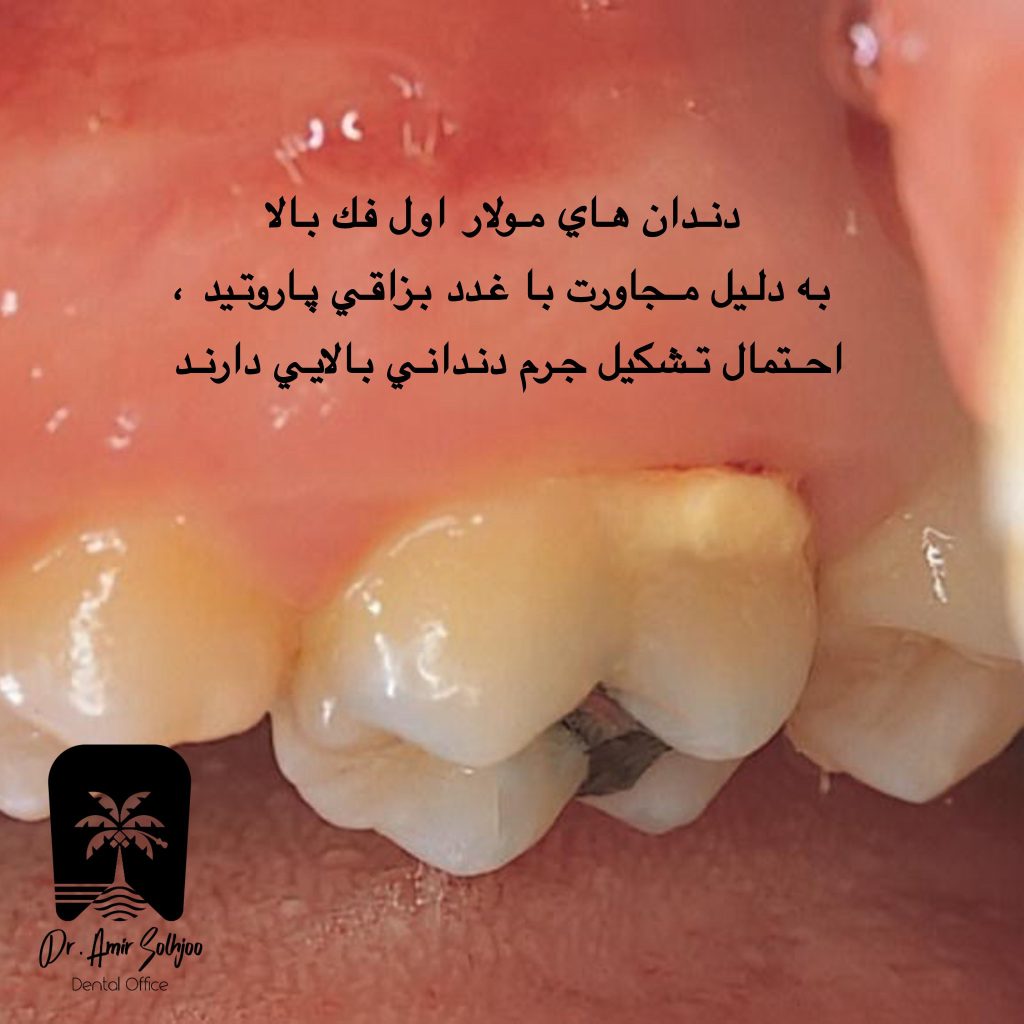 دندان مولر یا آسیاب بزرگ
