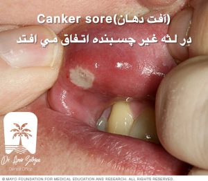 آفت دهان در لثه