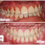 جینجیوکتومی یا لیفت لثه