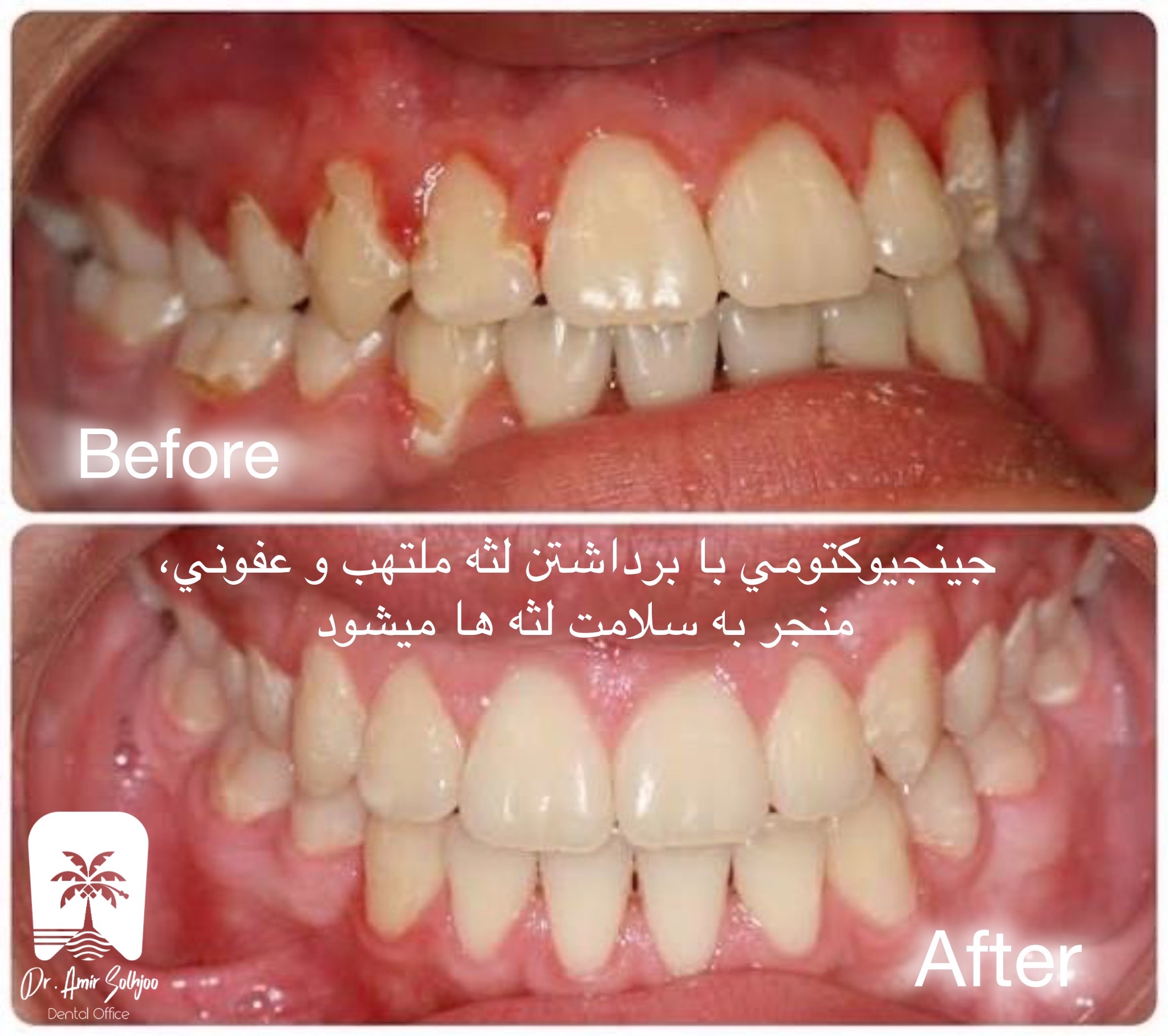 جینجیوکتومی یا لیفت لثه