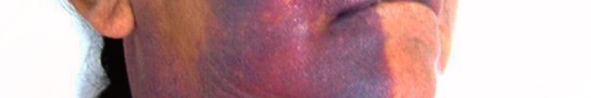 حادثه هیپوکلرایت