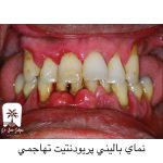 پریودنت تهاجمی
