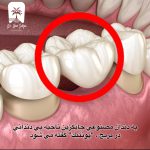 پونتیک دندان