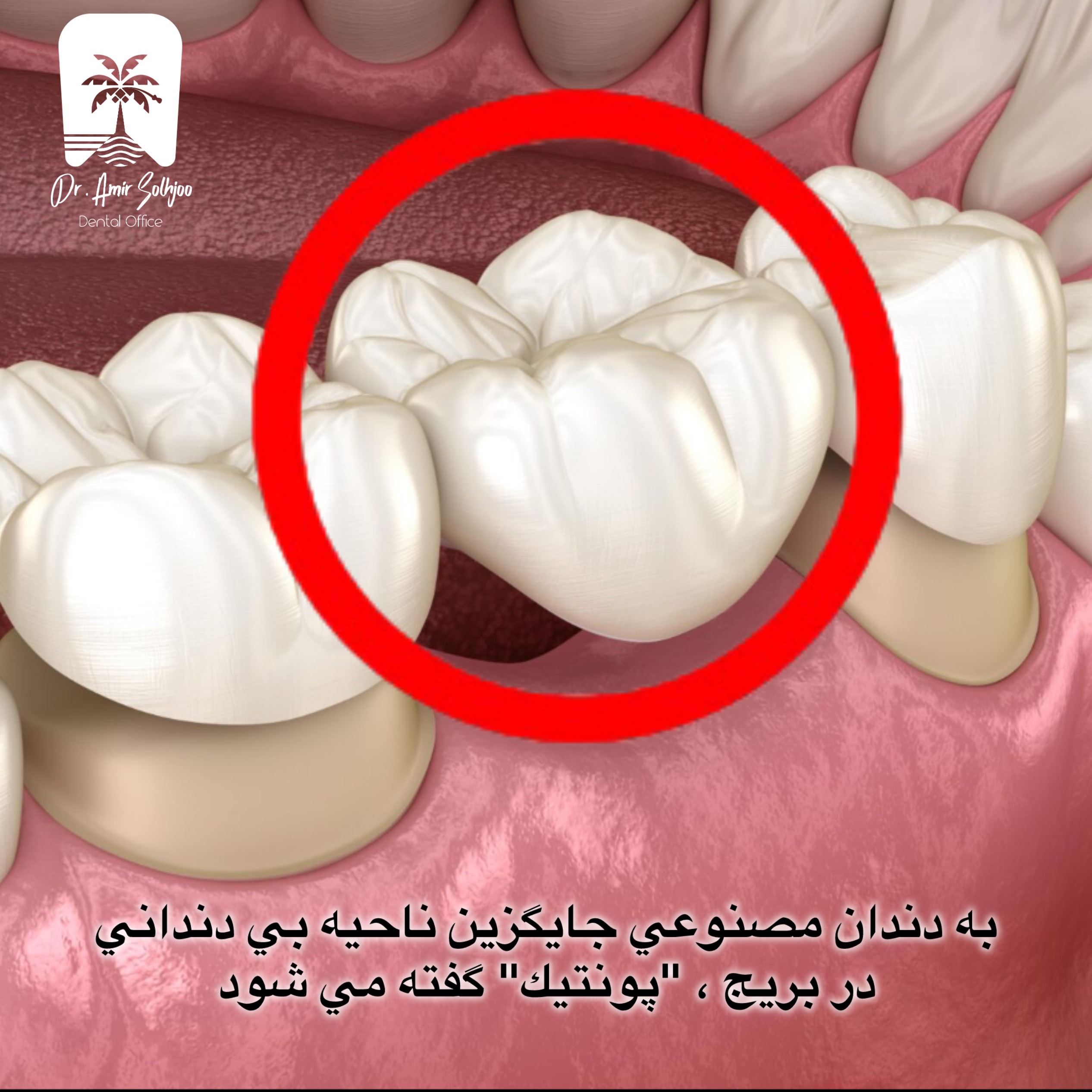 پونتیک دندان