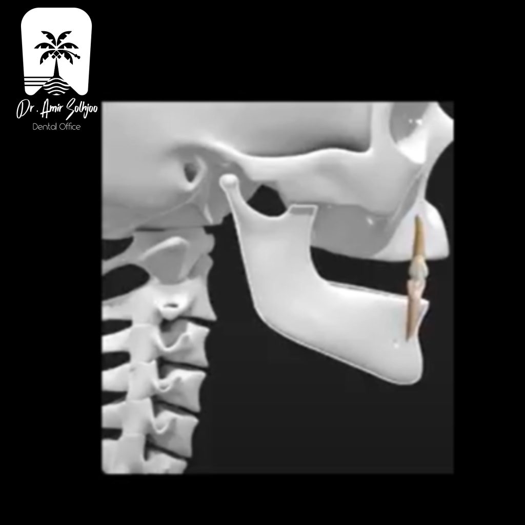 canine rise یا حرکت طرفی فک بر پایه ی رانش روی دندان نیش