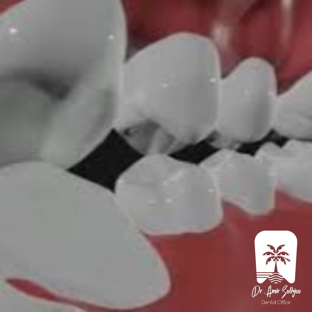2.group function یا عملکرد گروهی در حرکات طرفی فک که دندان های بای کاسپید یا premolar نیز در آن نقش ایفا می کنند.