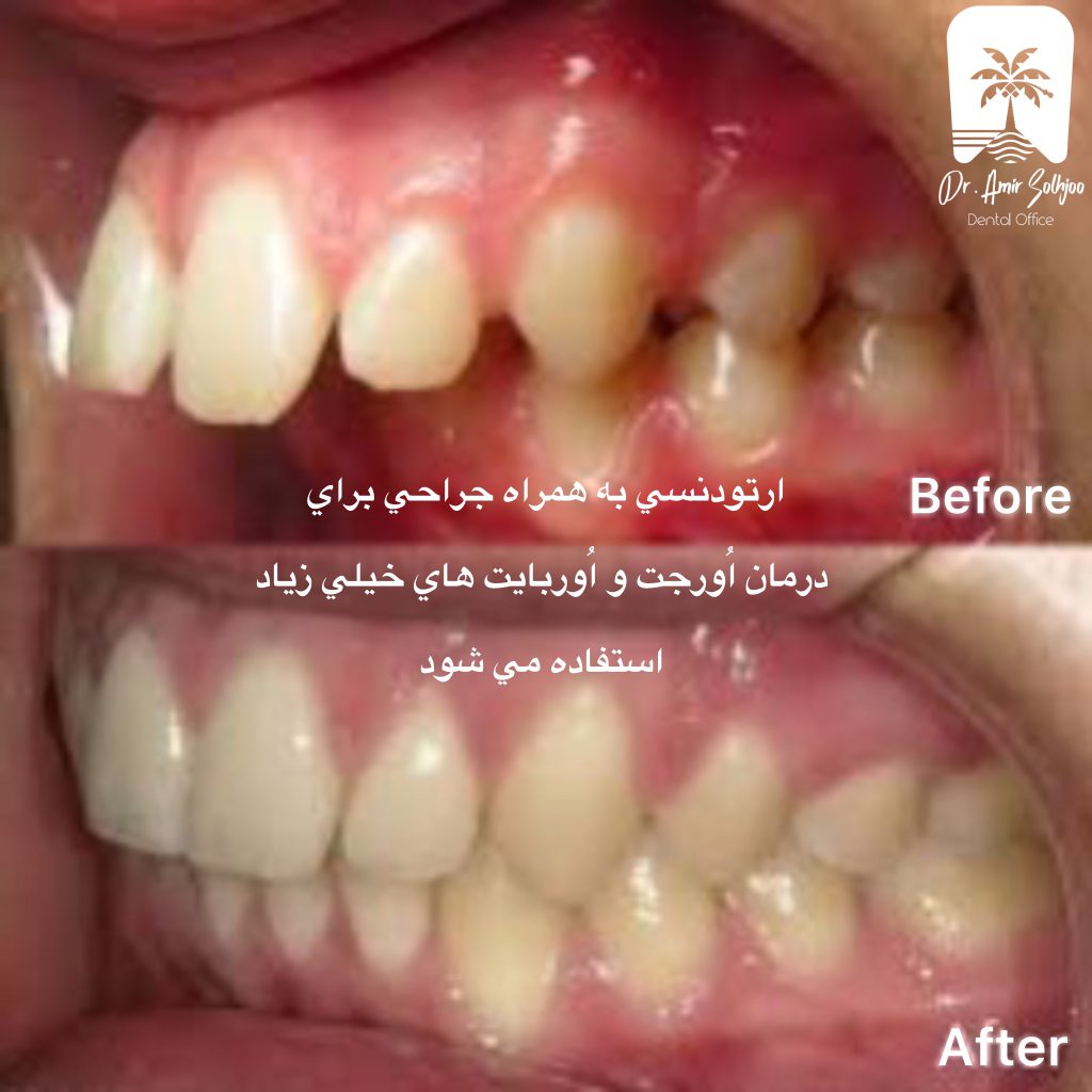 ارتودنسی برای اورجت و اوربایت