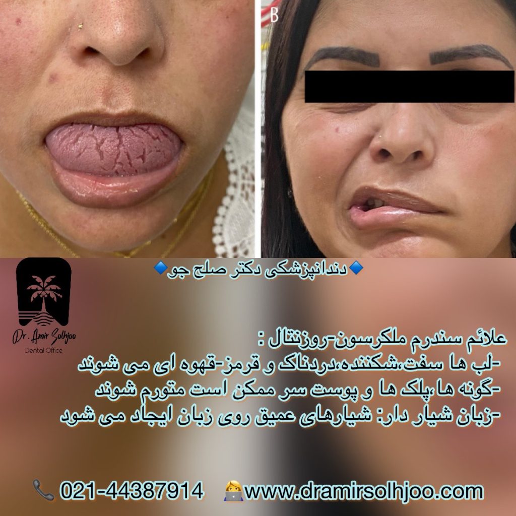 سندرم ملکرسون روزنتال
