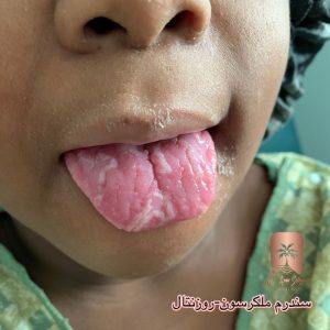 سندرم ملکرسون روزنتال