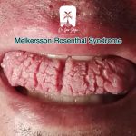 سندرم ملکرسون روزنتال