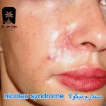 سندرم نیکولا