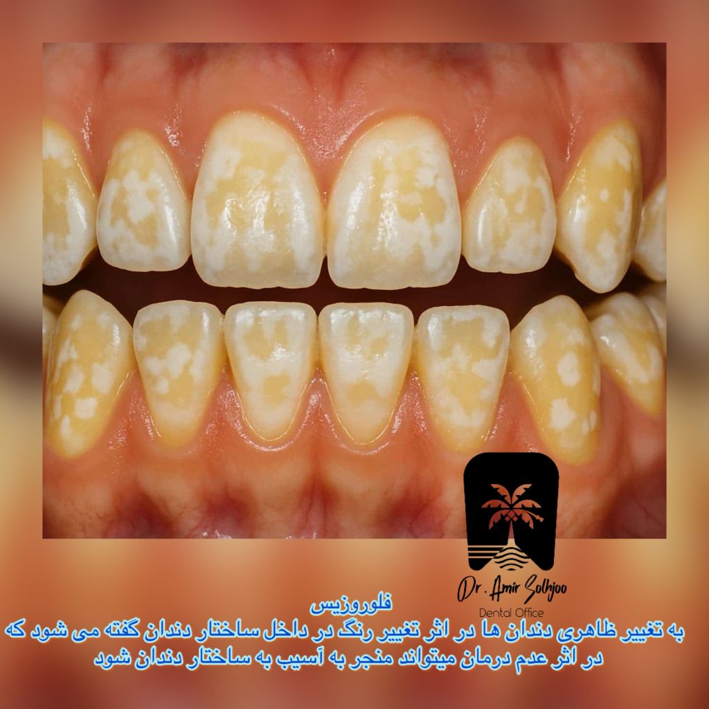 فلوروزیس دندان