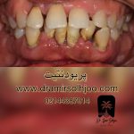 پریودنتیت