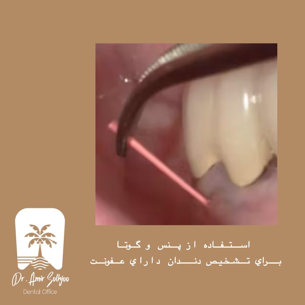 پنس رول پنبه