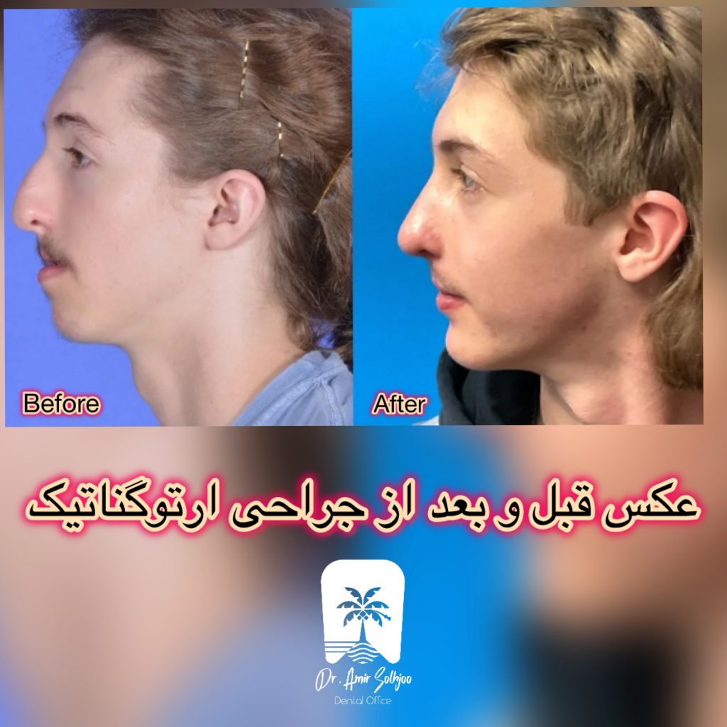 عکس قبل و بعد جراحی ارتوگناتیک
