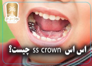 اس اس کراون ss crown چیست؟