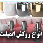 انواع روکش‌ ایمپلنت