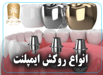 انواع روکش‌ ایمپلنت