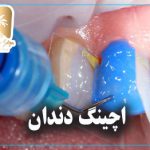 اچینگ دندان