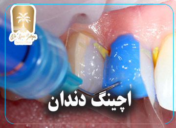اچینگ دندان