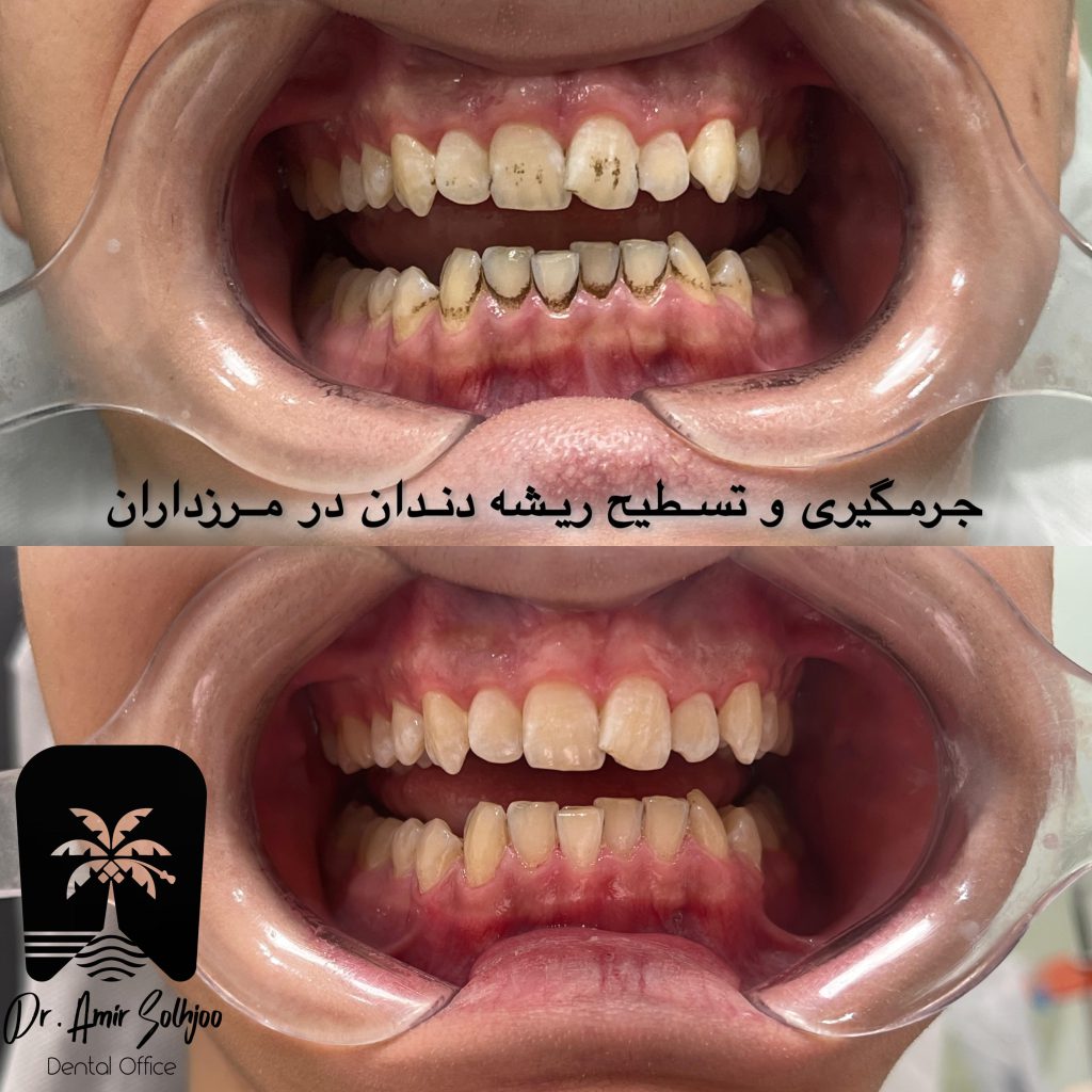 نمونه عکس جرمگیری