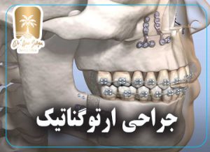 جراحی ارتوگناتیک یا ارتوسرجری