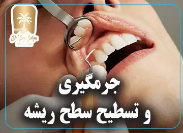 جرمگیری و تسطیح سطح ریشه