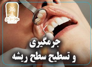 جرمگیری و تسطیح سطح ریشه