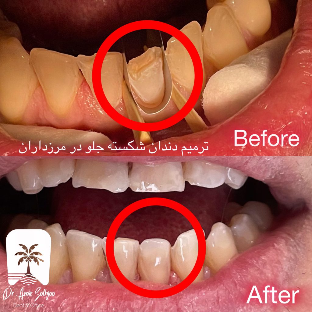 کامپوزیت رزین