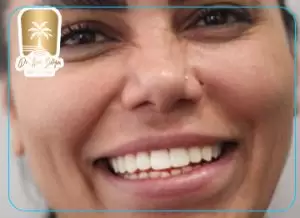 لمینت