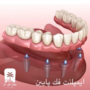 ایمپلنت فک پایین