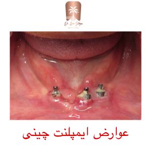 کیفیت ایمپلنت های چینی