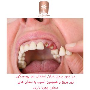 مقایسه هزینه و زمان درمان ایمپلنت و بریج