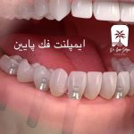 ایمپلنت فک پایین