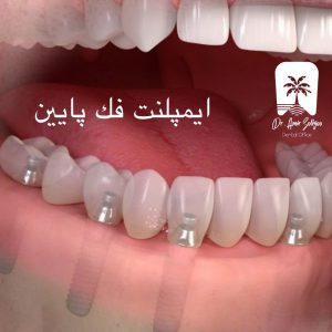 ایمپلنت فک پایین