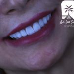 کامپوزیت لبه شیشه ای