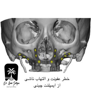 خطر عفونت و التهاب ناشی از عوارض ایمپلنت چینی