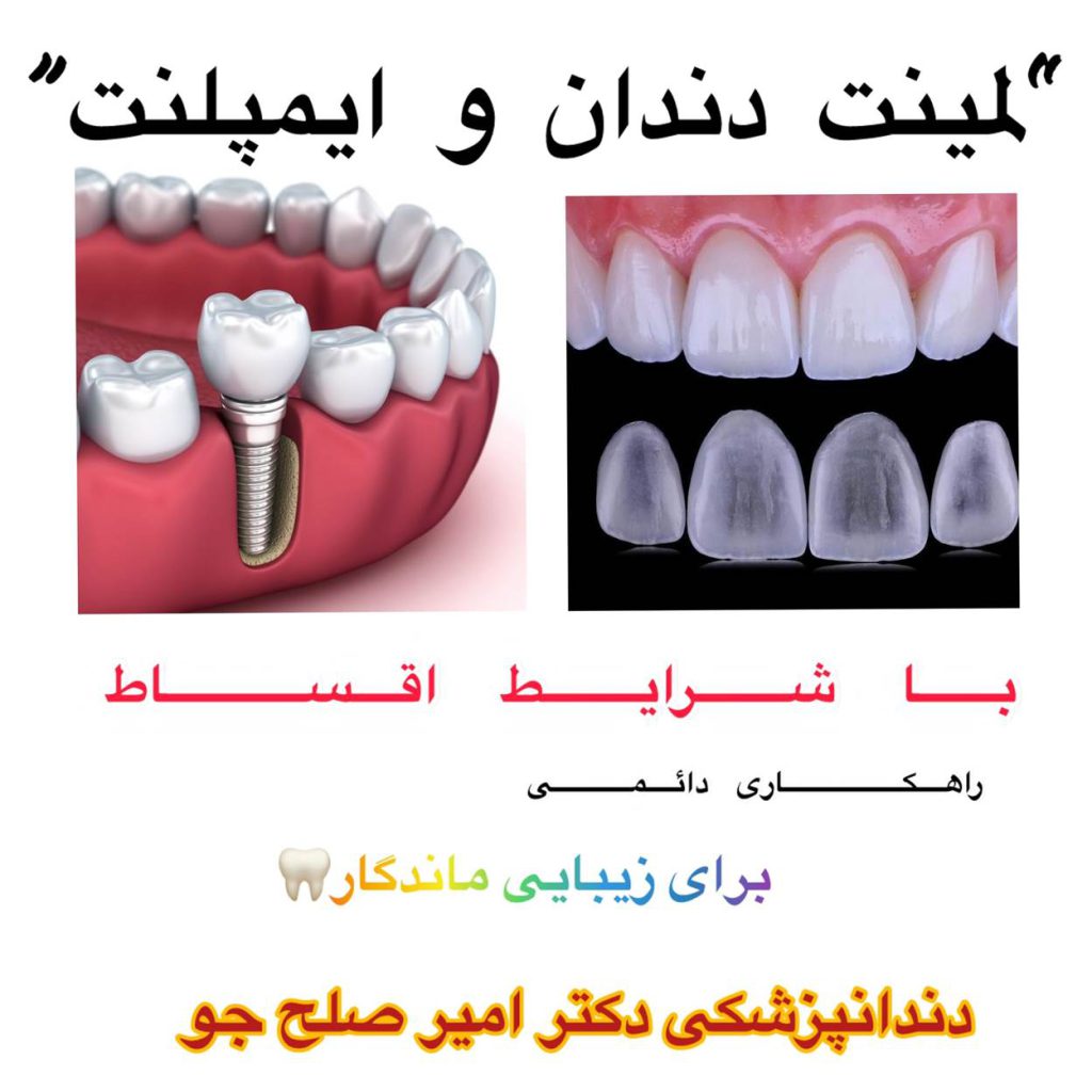 لمینت و ایمپلنت اقساطی در غرب تهران