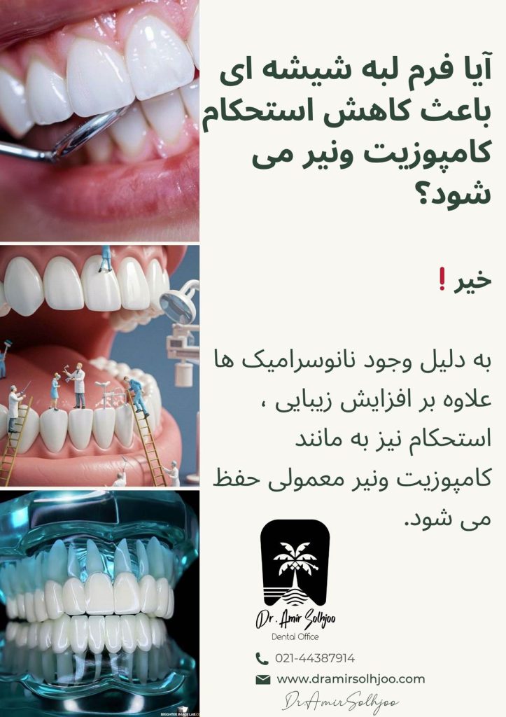 تفاوت کامپوزیت لبه شیشه ای با کامپوزیت ونیر