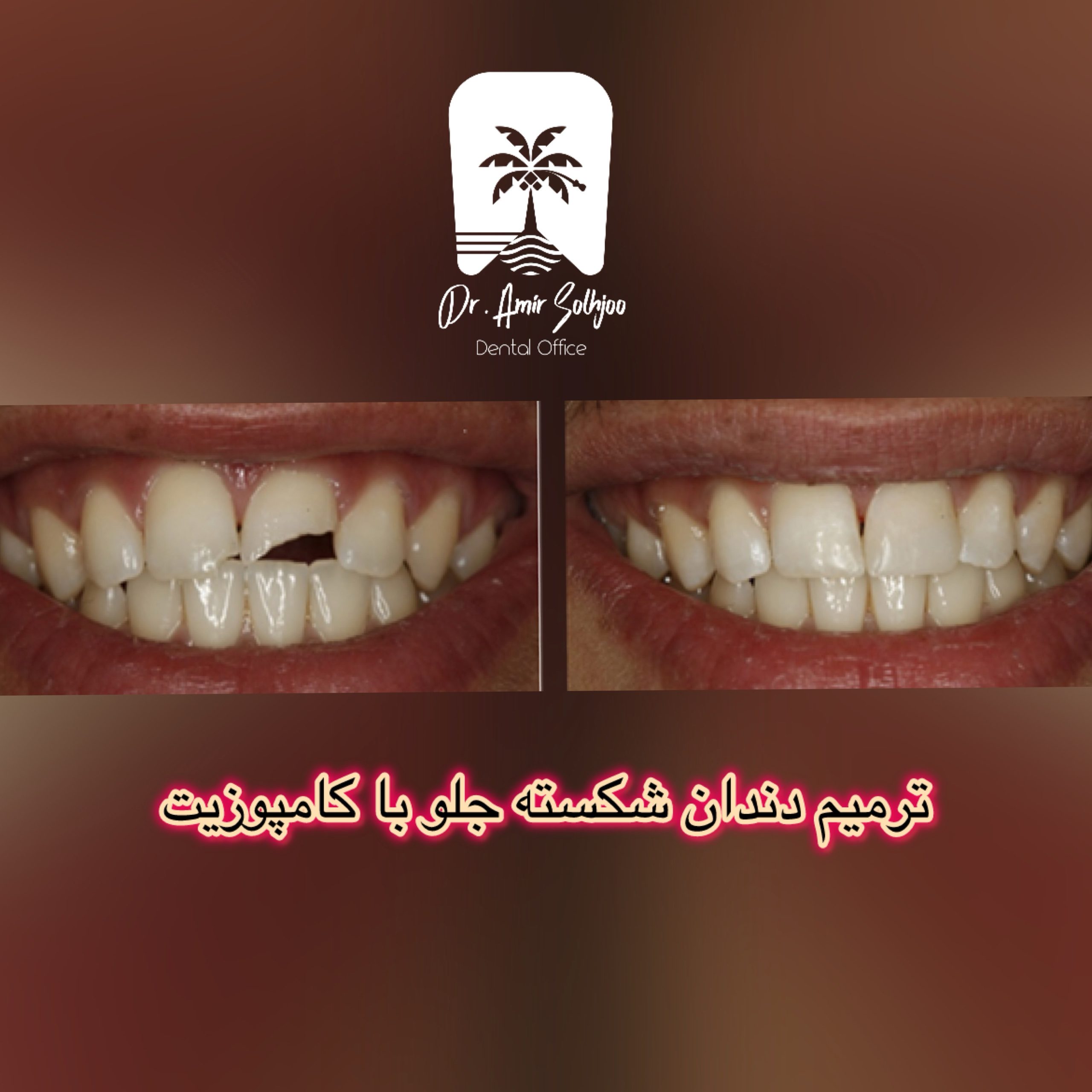 ترمیم دندان شکسته جلو با کامپوزیت