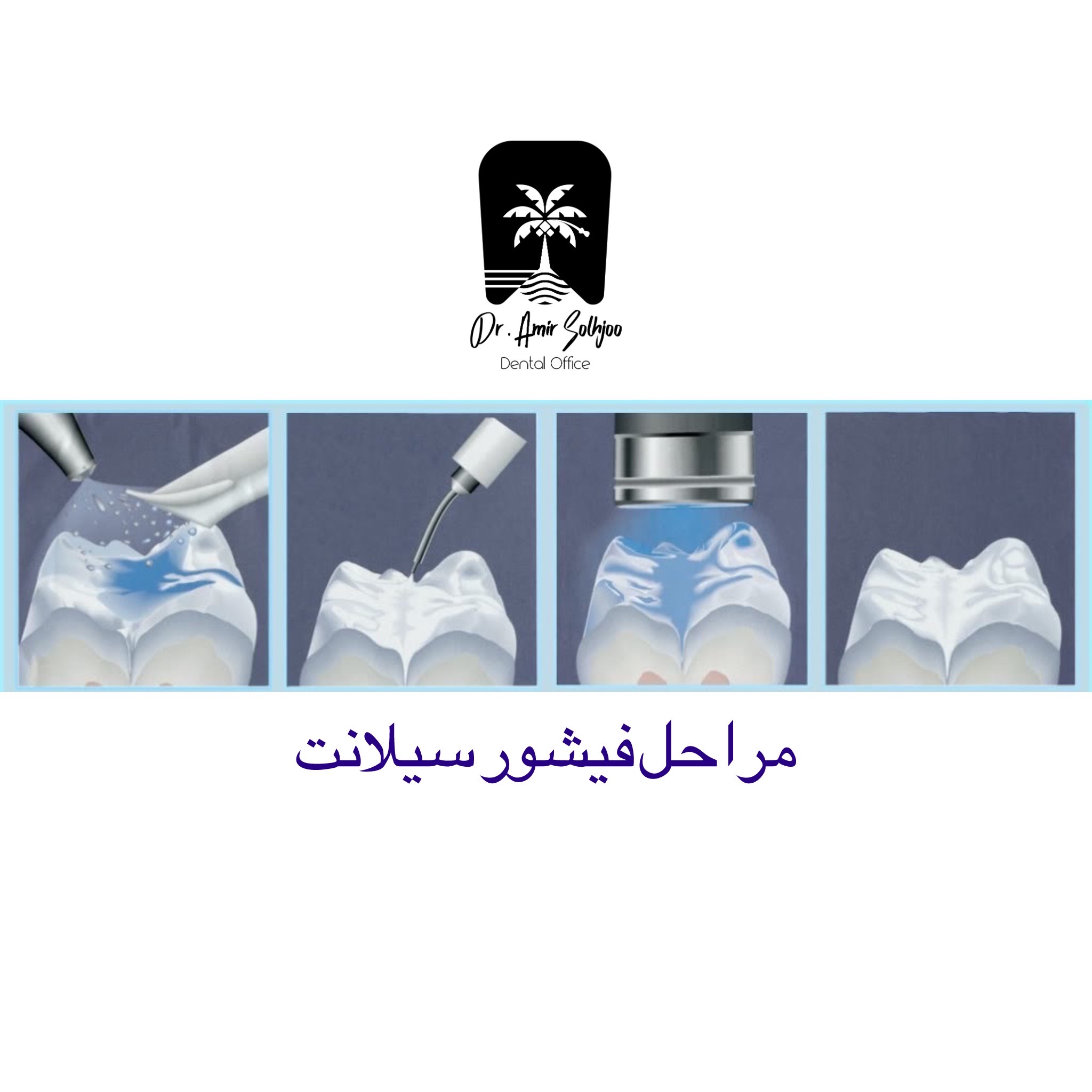 مراحل انجام فیشور سیلانت