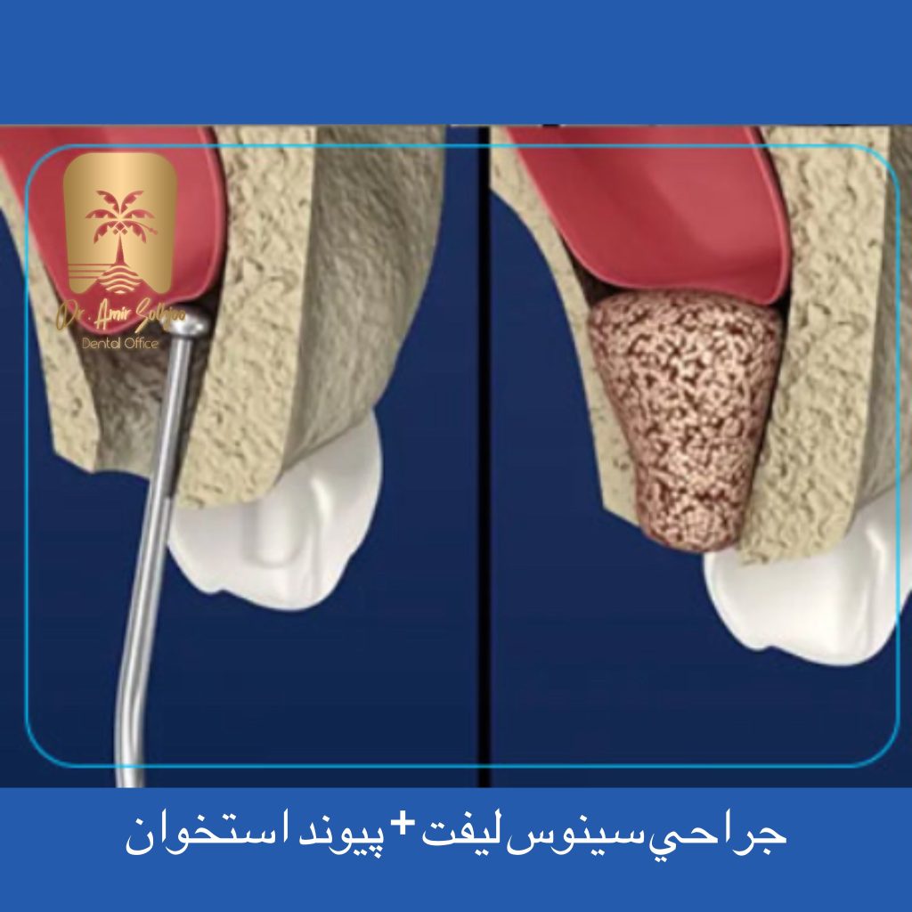 تکنیکهای پیوند استخوان و سینوس لیفت