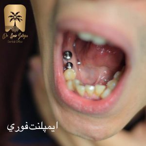 ایمپلنت فوری