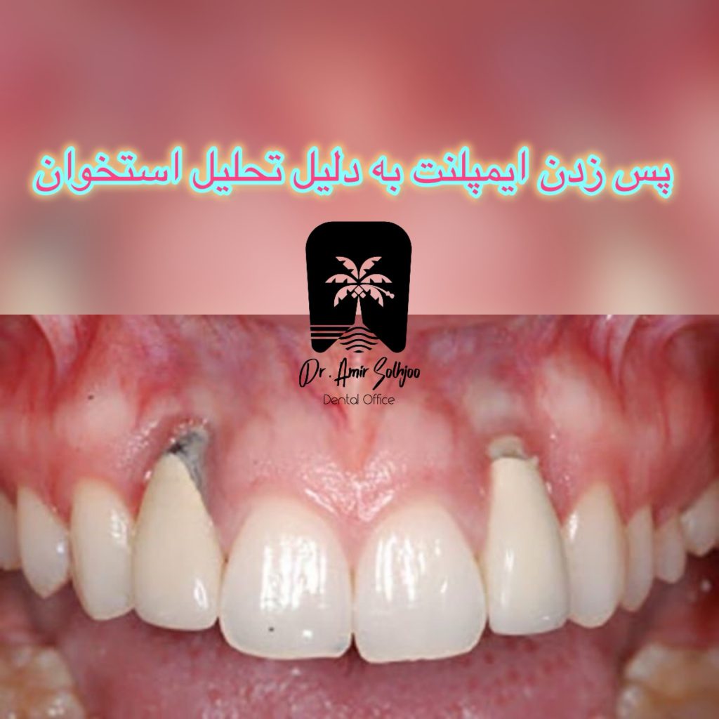 عوارض ایمپلنت دندان به دلیل تحلیل استخوان